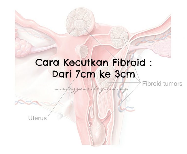 Cara Kecutkan Fibroid : Dari 7cm ke 3cm