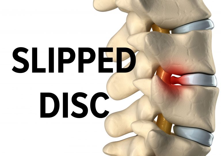 Slip Disc Cara Rawat Berkesan Tanpa Pembedahan