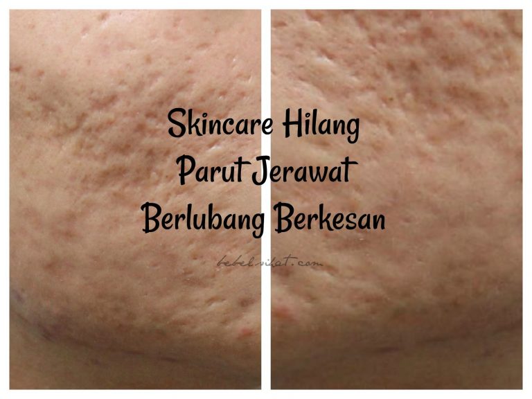 Skincare Hilang Parut jerawat Berlubang Berkesan